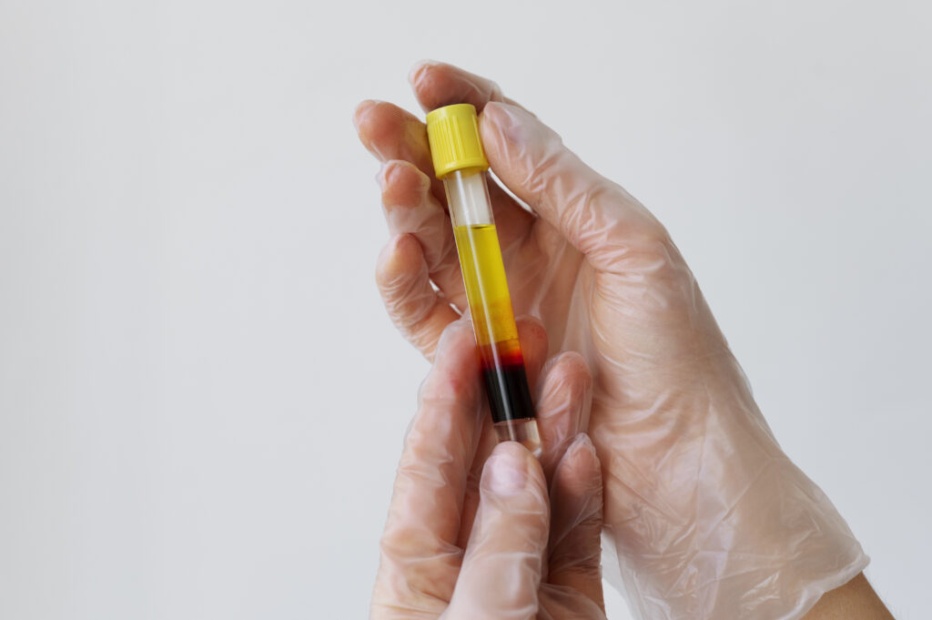 PRP: cos’è, come funziona e quando serve | Guida scientifica